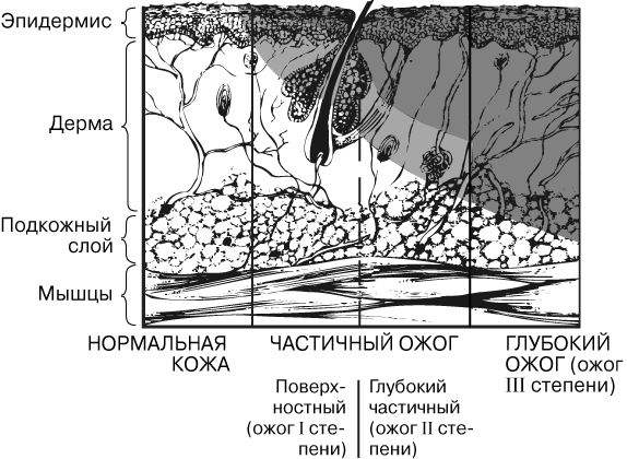 Описание: СТЕПЕНИ ОЖОГОВ. Темным показана омертвевшая в результате ожога ткань, более светлым – поврежденная ткань, способная к восстановлению.
