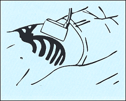 Схема наложения датчика для получения подреберного среза печени.