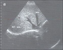 Эхограмма - поперечный срез здоровой печени.