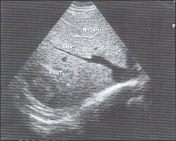 Подреберный косой срез через правую долю печени (эхограмма).