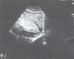 Медиальный и латеральный сегменты левой доли печени (эхограмма).