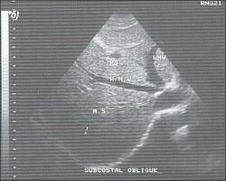 Нормальное изображение печеночных вен (эхограмма).