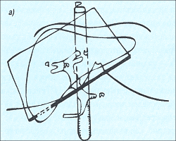 Уровень бифуркации достигается при направлении датчика немного каудально (схема).