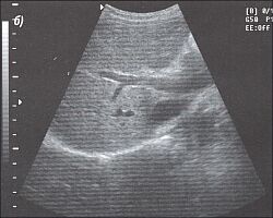 Нормальное изображение воротных вен на уровне бифуркации (эхограмма).