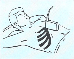 Продольное сканирование печени - схема наложения датчика.