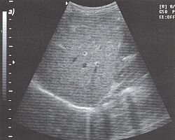 Продольный срез печени через правую долю (эхограмма).