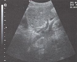 Продольный срез печени через левую долю (эхограмма).