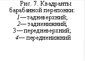 Рис. 7. Квадранты барабанной перепонки: 1— задневерхний; 2— задненижний; 3— передневерхний; 4— передненижний 