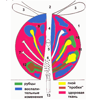 Описание: Описание: Простатит. Заболевания половых органов