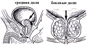 Описание: Описание: Простатит. Заболевания половых органов