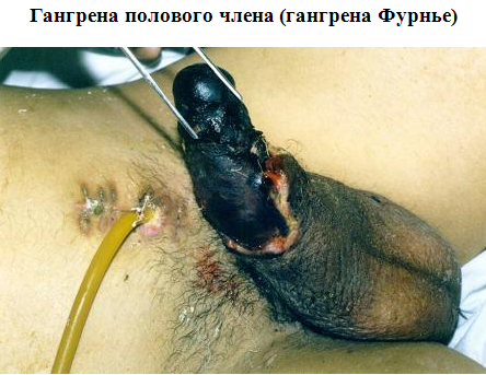 Описание: Простатит. Заболевания половых органов